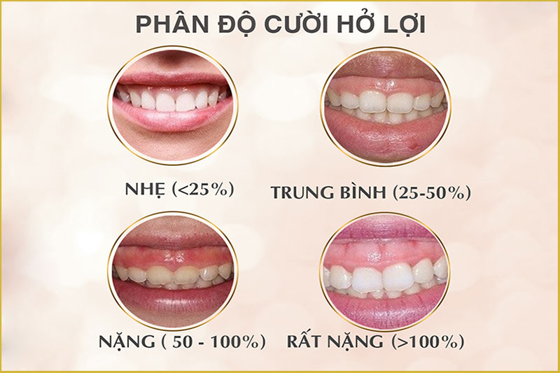 các mức độ cười hở lợi